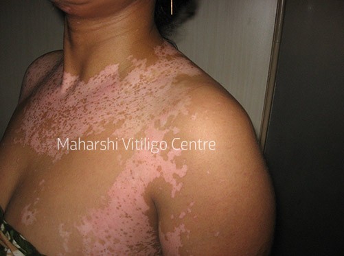 Vitiligo Centre Indore - Before