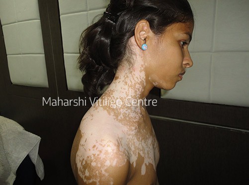 Vitiligo Centre Indore - Before