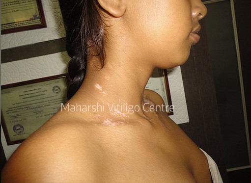 Vitiligo Centre Indore - After
