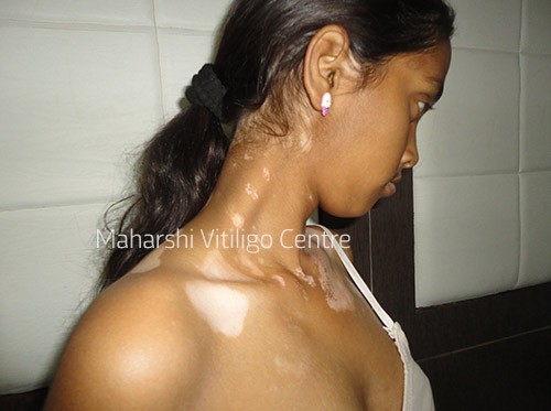 Vitiligo Centre Indore - Before