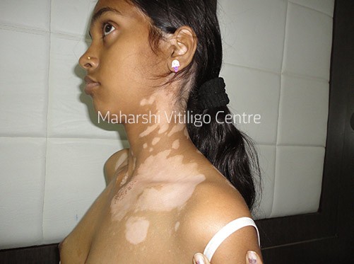 Vitiligo Centre Indore - Before