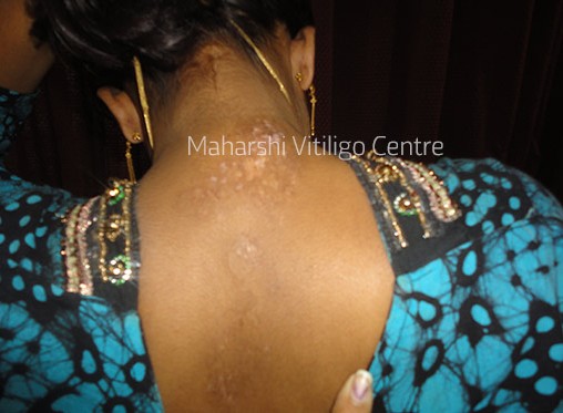 Vitiligo Centre Indore - After