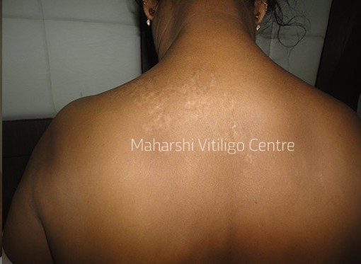 Vitiligo Centre Indore - After