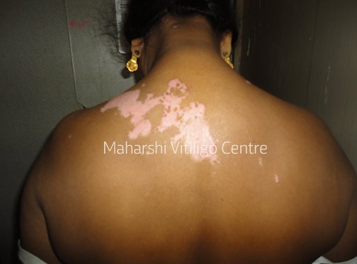 Vitiligo Centre Indore - Before