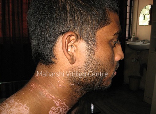 Vitiligo Centre Indore - After