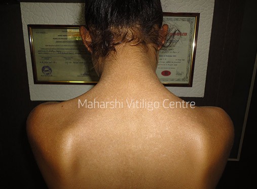 Vitiligo Centre Indore - After