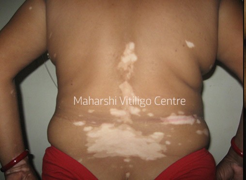 Vitiligo Centre Indore - Before
