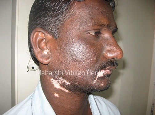 Vitiligo Centre Indore - Before