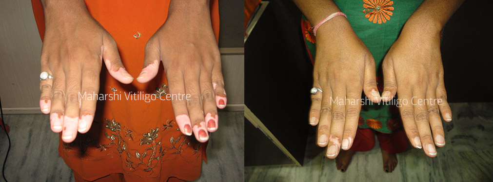 Vitiligo Centre Indore - After