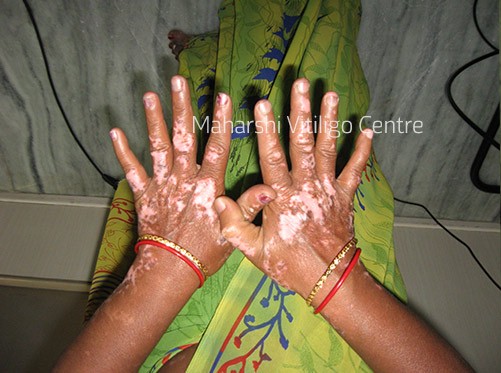 Vitiligo Centre Indore - After