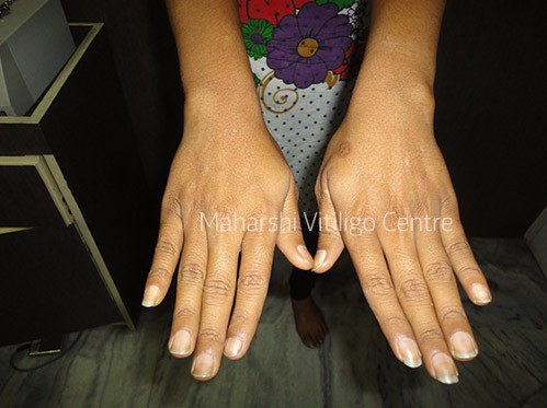 Vitiligo Centre Indore - After