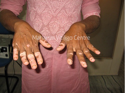 Vitiligo Centre Indore - Before