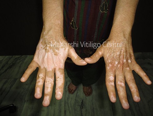 Vitiligo Centre Indore - After
