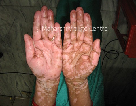 Vitiligo Centre Indore - Before