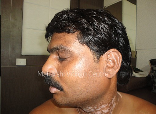 Vitiligo Centre Indore - After