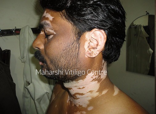 Vitiligo Centre Indore - Before