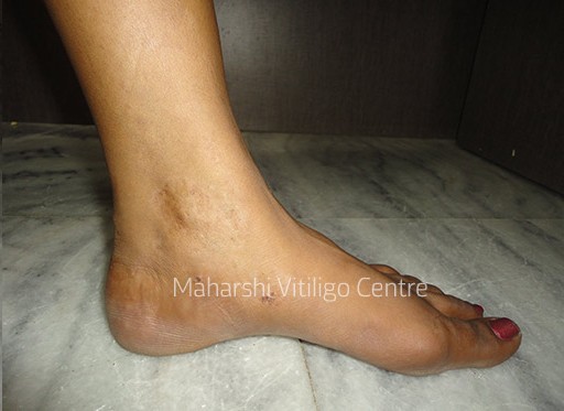 Vitiligo Centre Indore - After